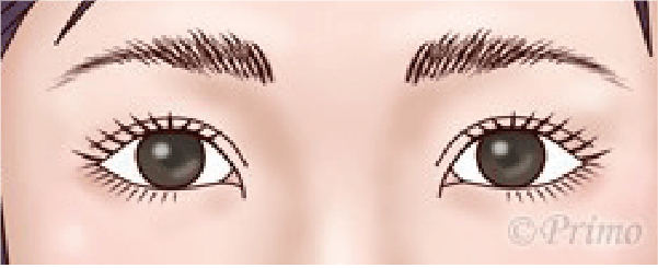 眼瞼下垂手術後のイメージ